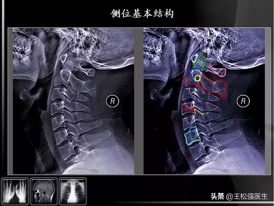 颈椎X光片