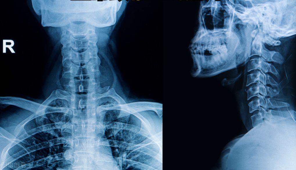 x光片说颈椎,颈椎不舒服的正确睡姿是什么?平时需注意这些