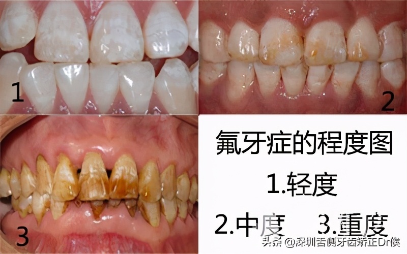 氟斑牙怎么治？