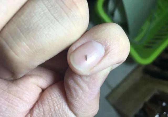 20年前男女老少都有的虱子，为何却消失了？