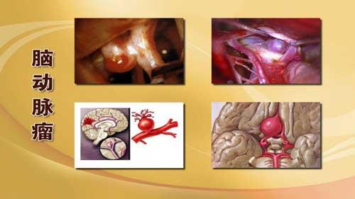 脑动脉瘤手术放支架可靠吗？三甲医院脑血管医生一席话让你放宽心