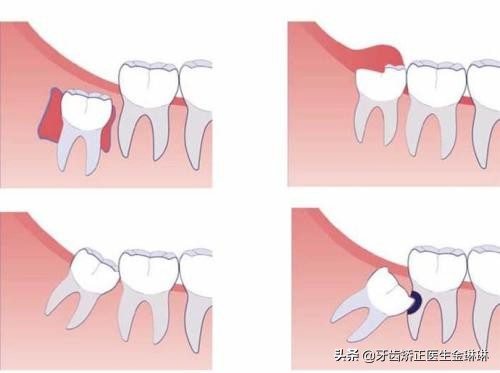 躺着,还经常造成牙龈肿痛,发炎,影响进食,医生通常建议这种不良智齿是