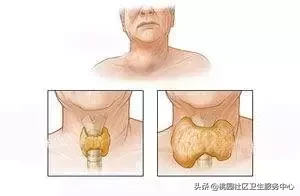 在哪个时段注意甲状腺危象(一文总结甲状腺危象的识别和急救)