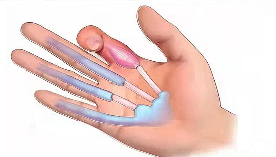 中老年女性常手指疼痛、肿胀，是腱鞘炎吗？该怎么办？告知您