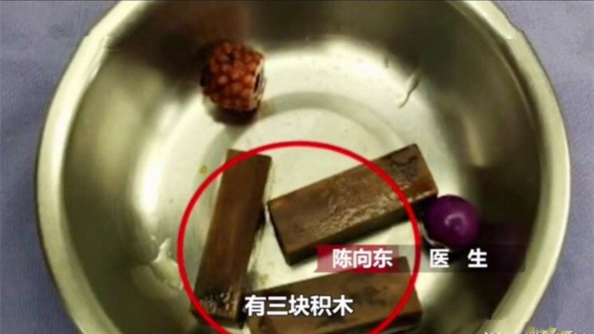 女童私处发出恶臭，经手术竟在下体取出这么多异物，父母们别大意