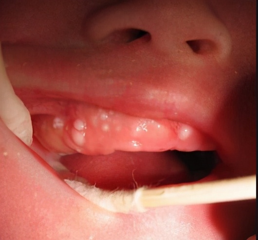 致,对宝宝没有任何影响上颚一串白色小结节,由于上皮细胞在上颚处聚集