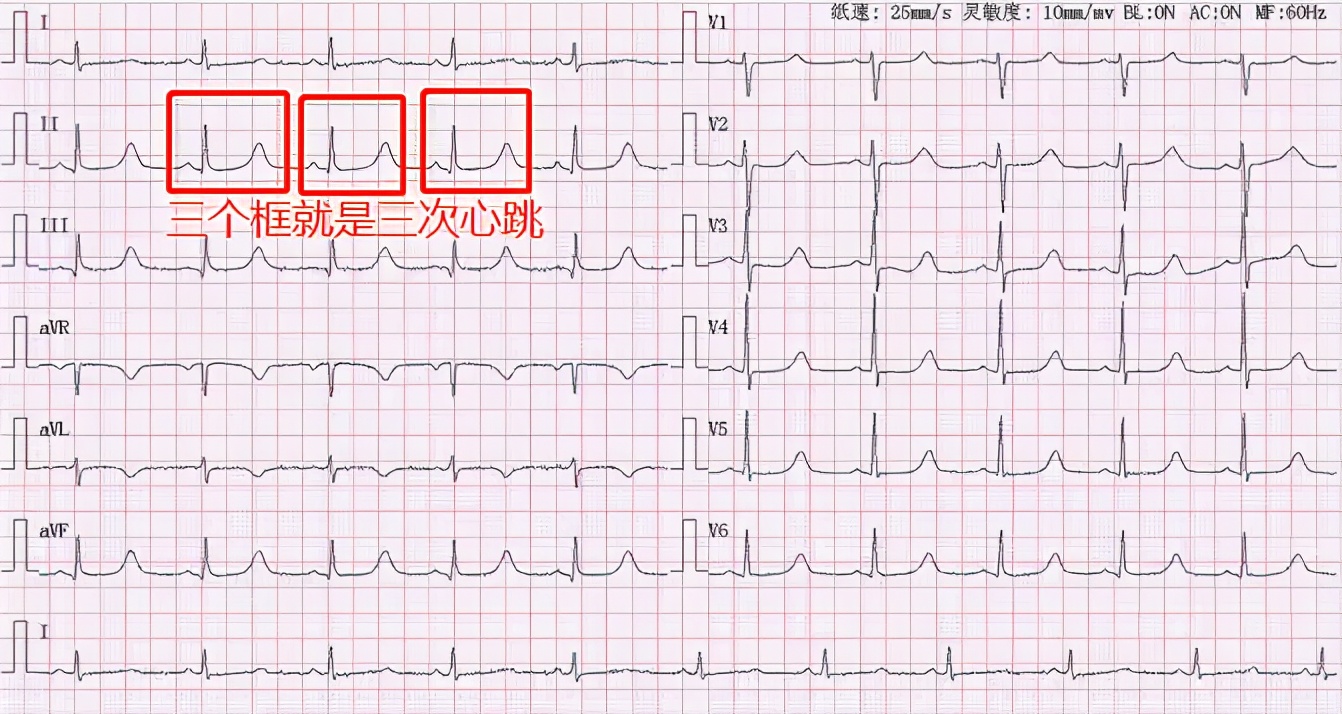 普通人怎么看心电图？医生说：把图上的线条和心脏的跳动结合起来