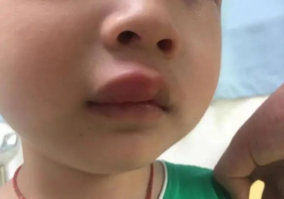 2岁孩子半夜嘴巴肿了，妈妈带去医院，医生：2岁内别吃这食物