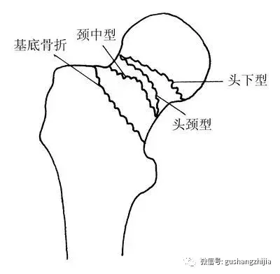 何必长期卧床--股骨颈骨折