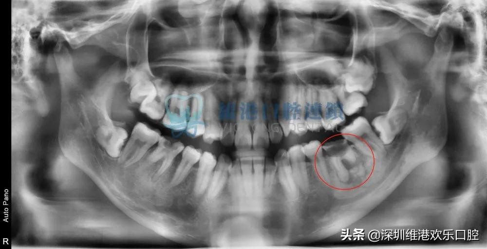 根尖囊肿免费公益筛查，防止牙槽骨破坏和脸部畸形