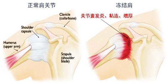 「双11福利」澳洲国宝级关节膏，摆脱肩颈、关节痛，只需抹一抹！