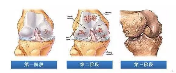 「双11福利」澳洲国宝级关节膏，摆脱肩颈、关节痛，只需抹一抹！