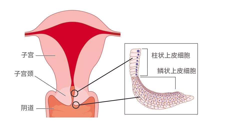 臨床上稱其為「宮頸柱狀上皮異位」