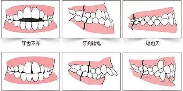 昆明隐适美哪里好柏德甲级(年终变美逆袭，隐形矫正仅需15700元，全年最低价！)