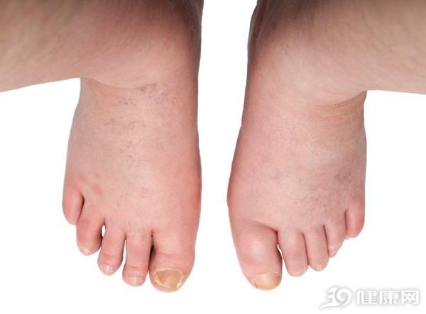 尿毒症是什么症状初期「尿毒症是什么症状表现尿不出来吗」-友友