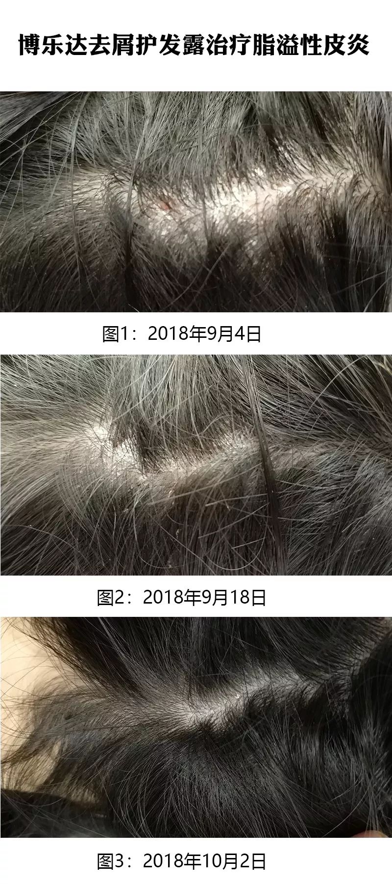 博乐达去屑护发露治疗脂溢性皮炎疗效总结