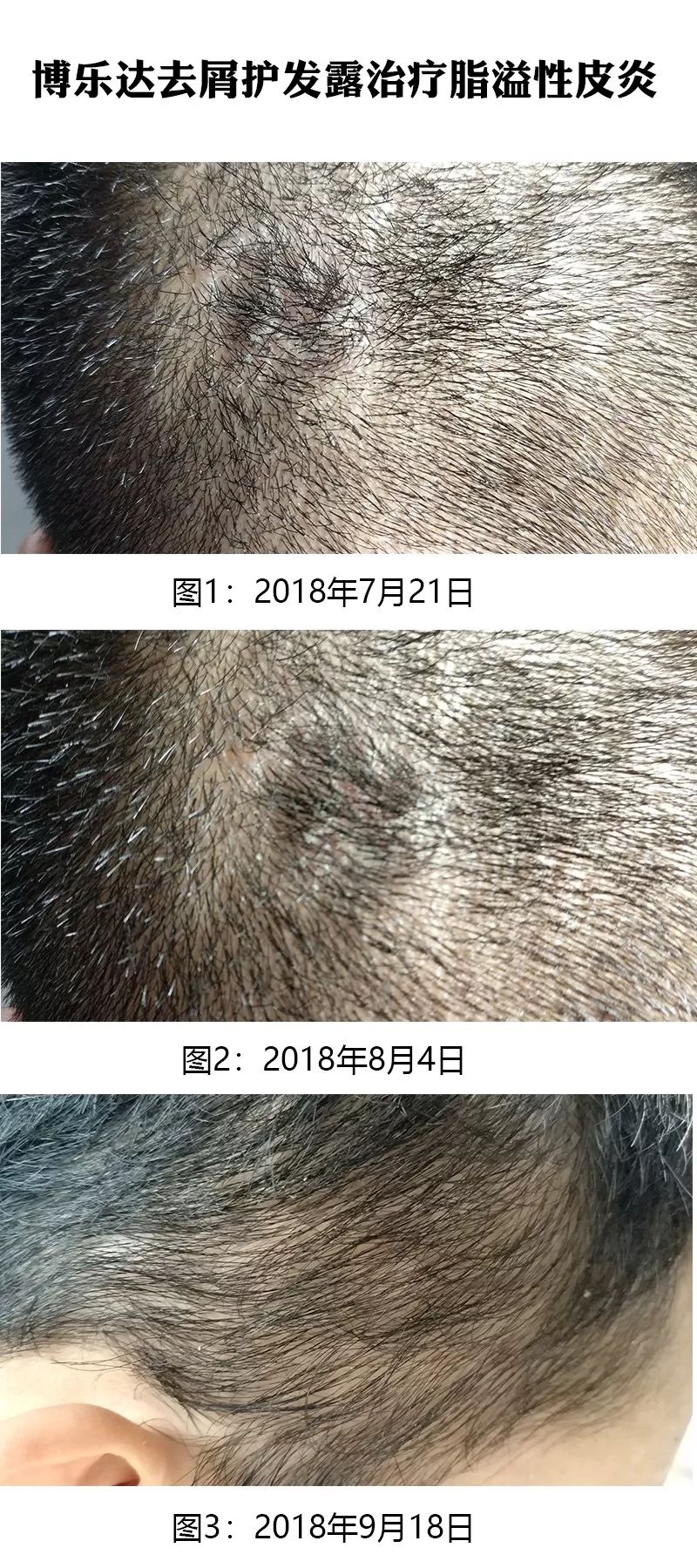 博乐达去屑护发露治疗脂溢性皮炎疗效总结