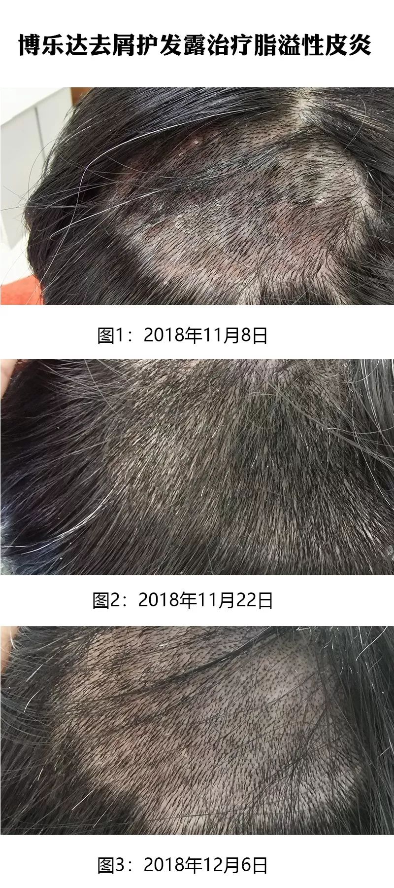 博乐达去屑护发露治疗脂溢性皮炎疗效总结