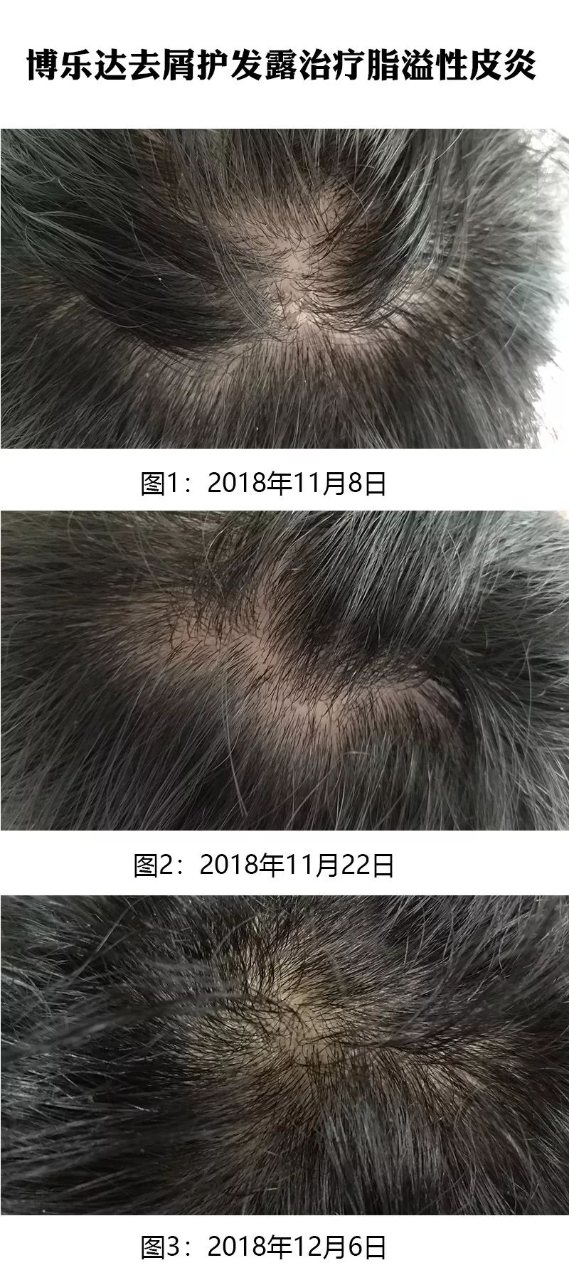 博乐达去屑护发露治疗脂溢性皮炎疗效总结