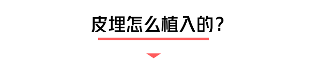 小小一根棒，比套套和上环安全，避孕率超高却少有人知道