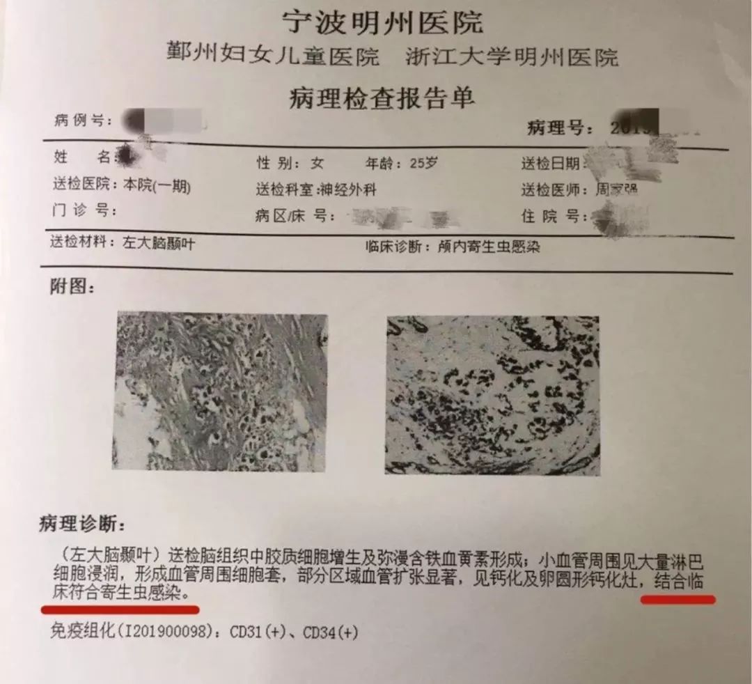 天呐！25岁女子多年头痛，竟因脑袋里有活物在"挖隧道"！