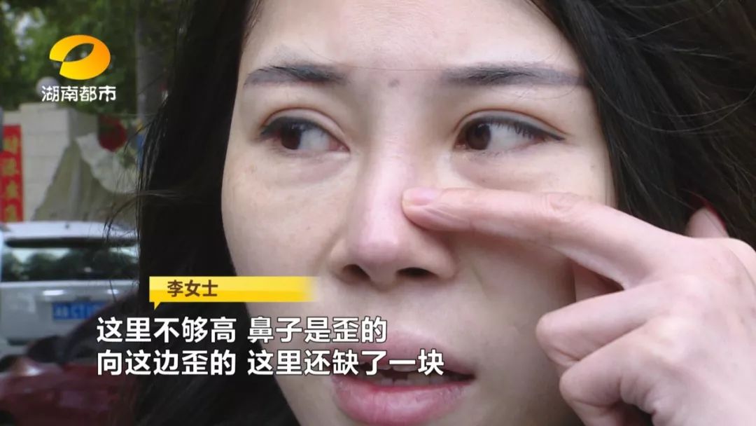 整一下鼻子多少钱(长沙一女子花费数万元隆鼻却整出“歪鼻子”！对方称半年就可修复，半年后，还是“歪的”！)