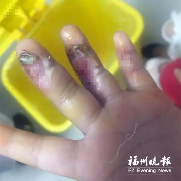 2岁男孩腿上出现一个凹陷的大洞！原因让人后怕！家中这些“杀手”一定要注意