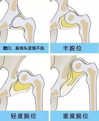 寶寶為什麼會腿紋不對稱?