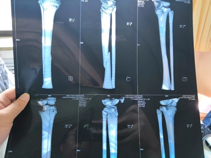 监控拍下揪心一幕！济南10岁女童玩蹦床，跳着跳着竟摔成骨折