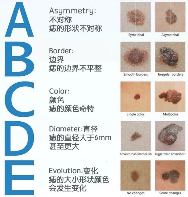 注意！千万别忽视你身上不起眼的黑痣，有可能……