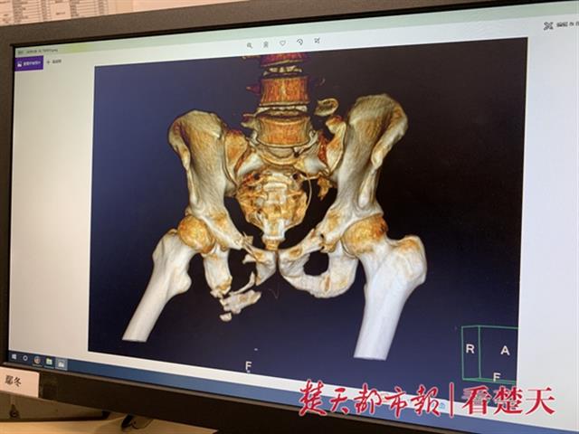 男子12米高空坠落盆骨粉碎几乎失掉全身血液，医生紧急堵住血管保住性命