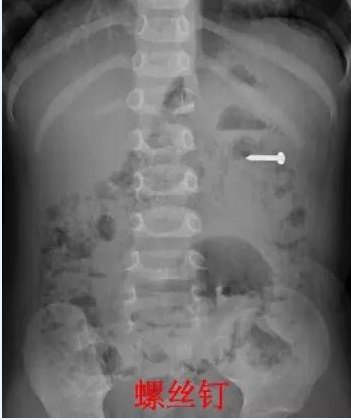 吓人！4岁娃儿吞下了一根5公分长的钢钉……
