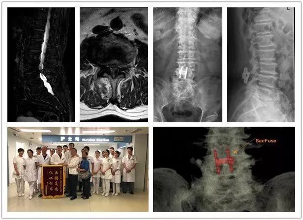 治疗腰椎退行性病变的新选择：棘突间融合撑开固定术