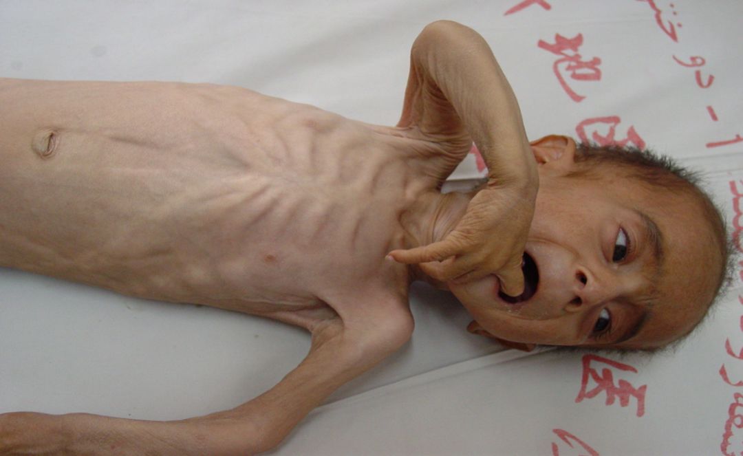 pew全称为「蛋白质-能量营养不良」,在慢性肾衰竭及透析患者中多见.