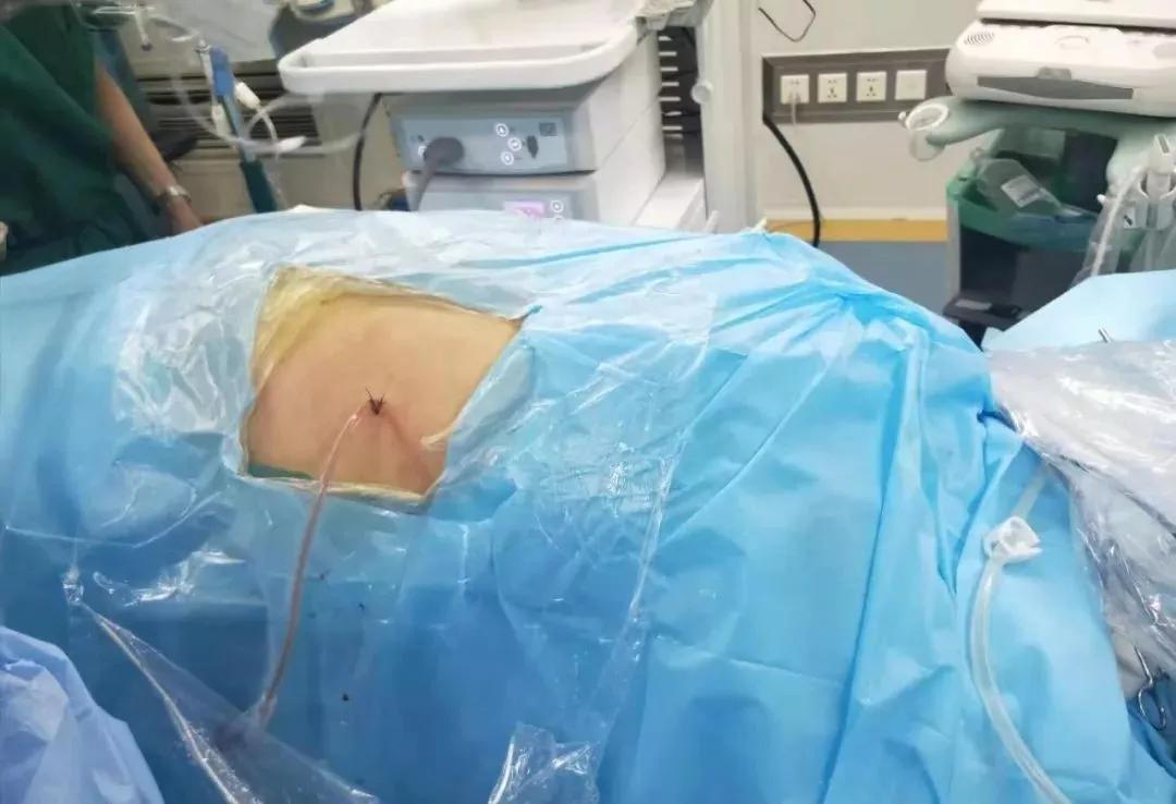 膀胱镜取结石手术过程图片