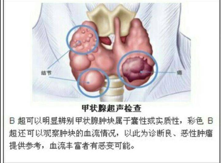甲状腺结节手术 甲状腺结节多大需要手术-游趣网