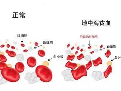 孕婦地中海貧血 孕婦地中海貧血是什麼病-起航號