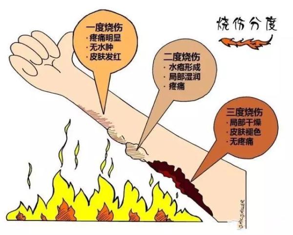 烧伤级别,烧伤级别划分标准