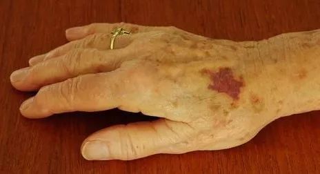 急性淋巴细胞白血病 白细胞高说明什么-世界十大百科