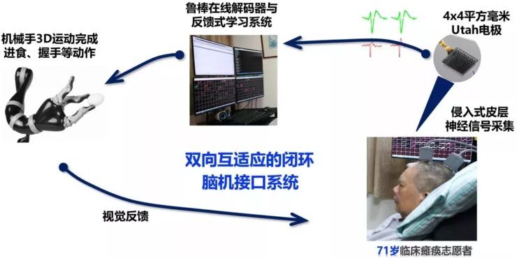 喜大普奔，国内首例植入式脑机接口临床研究取得突破性进展