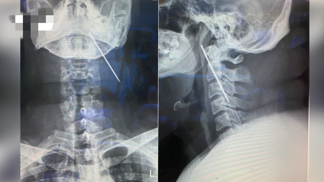男子咳嗽疑新冠肺炎就诊 竟发现8厘米钢钉卡颈部3年