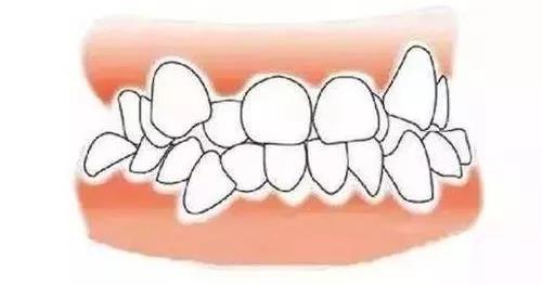 牙齿畸形图片(8种要矫正的牙齿畸形，看医前可对照自检)