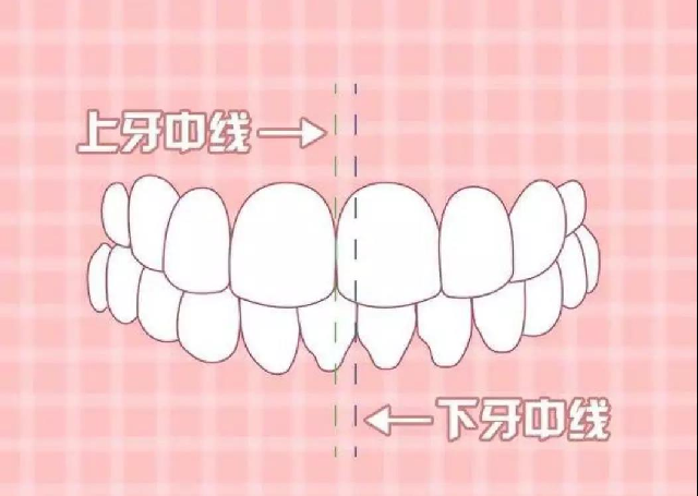 牙齿畸形图片(8种要矫正的牙齿畸形，看医前可对照自检)