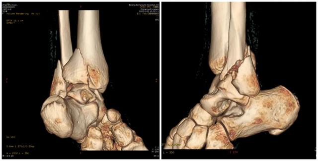 北亚踝关节骨折分型治疗