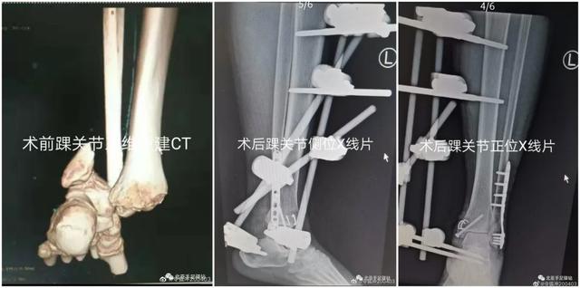 北亚踝关节骨折分型治疗