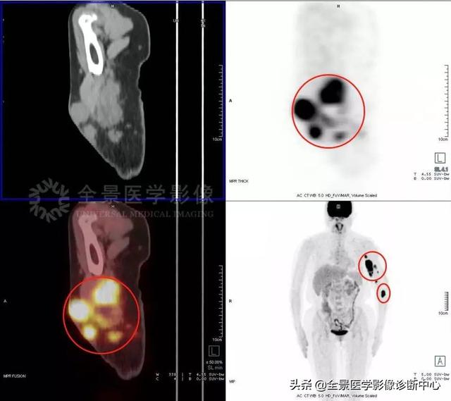 左手突然长了一颗痣（左手突然长了一颗痣有什么寓意）-第1张图片-科灵网