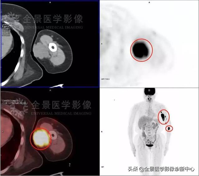 左手突然长了一颗痣（左手突然长了一颗痣有什么寓意）-第2张图片-科灵网