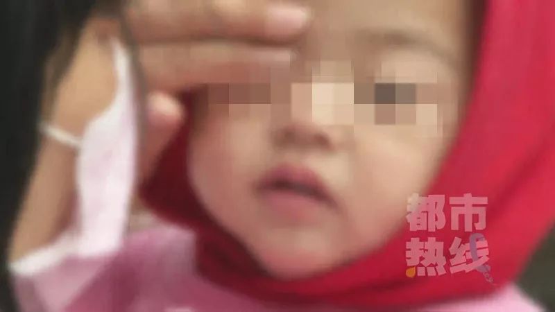 西安女子被自家狗扑咬重伤皮肤撕脱、多处骨折 为狂犬病Ⅲ级暴露