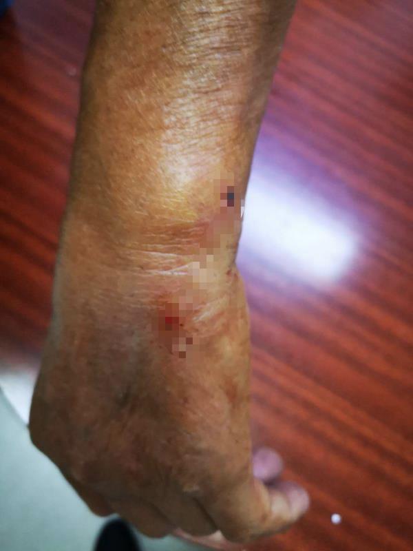 张大伯给大黄处理伤口的时候,不料,大黄一个不爽,直接咬了上来.