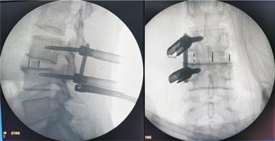 第一骨科 脊柱关节外科病房脊柱微创团队顺利完成斜外侧腰椎椎间融合经皮螺钉内固定术